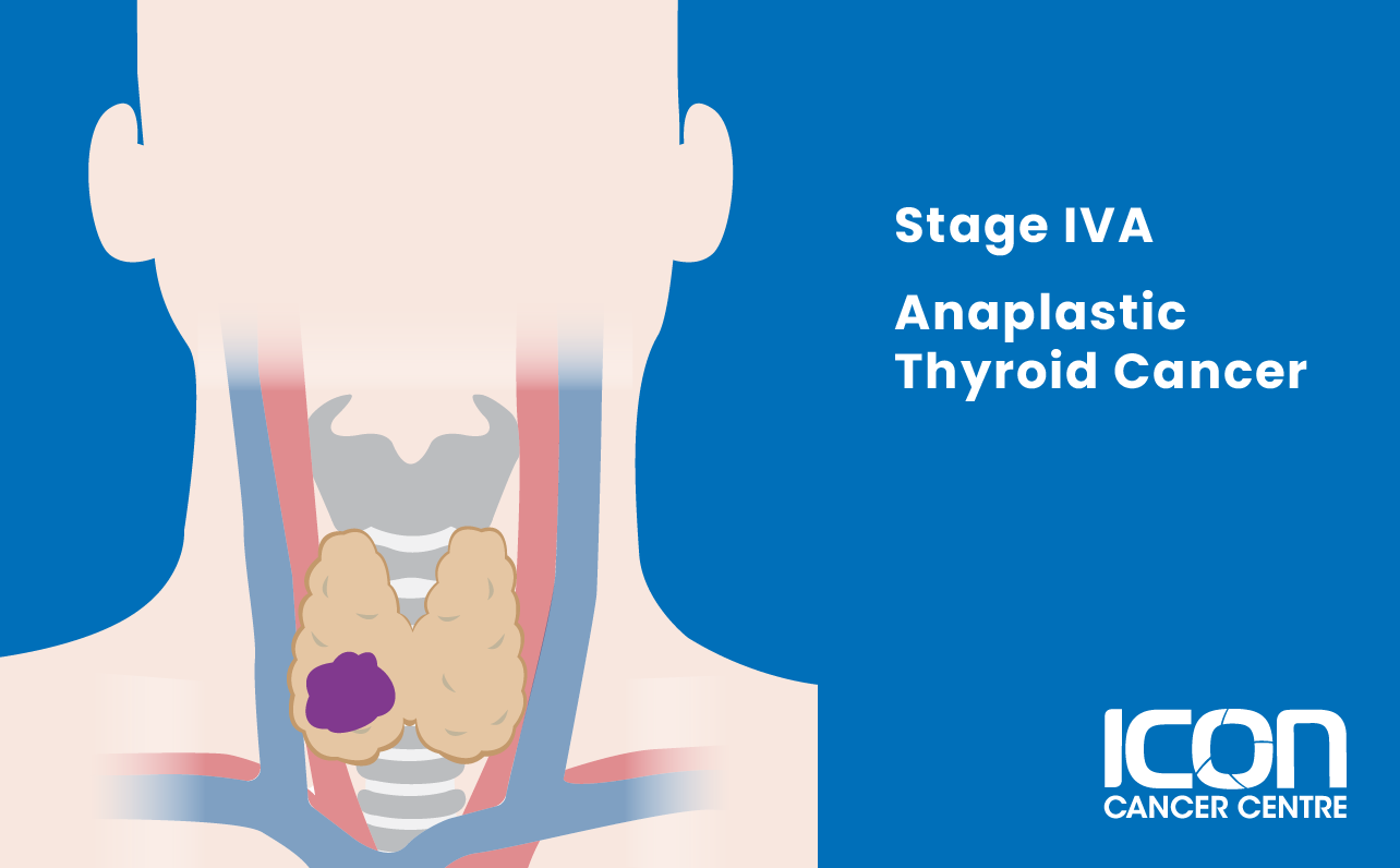 Stage IVA anaplastic thyroid cancer illustration